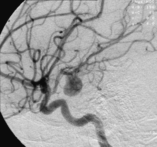 Digital subtraction angiogram — a saccular aneurysm arising from a cerebral artery.