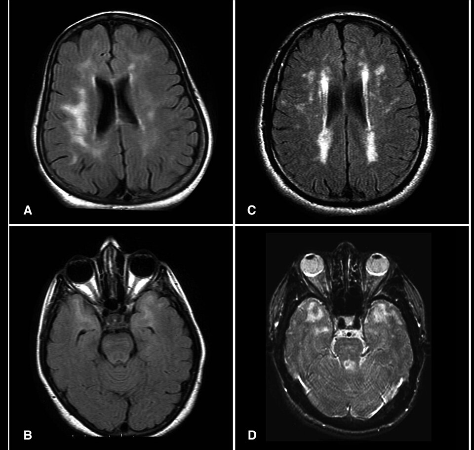 Axial FLAIR/T2 MRI — confluent periventricular and anterior-temporal white-matter hyperintensities with lacunes.