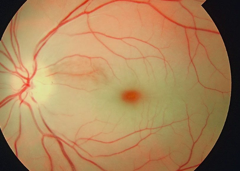 Fundus photograph — pale oedematous retina with a cherry-red macula in central retinal artery occlusion.