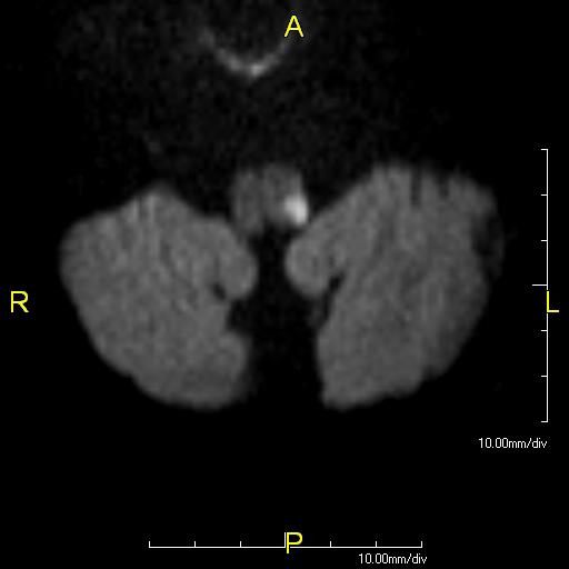 Diffusion-weighted MRI — restricted diffusion in the left dorsolateral medulla, the substrate of Wallenberg syndrome.
